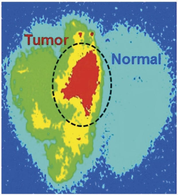 Belgische primeur: Chirurgen verwijderen hersentumor zonder feedback van patiënt