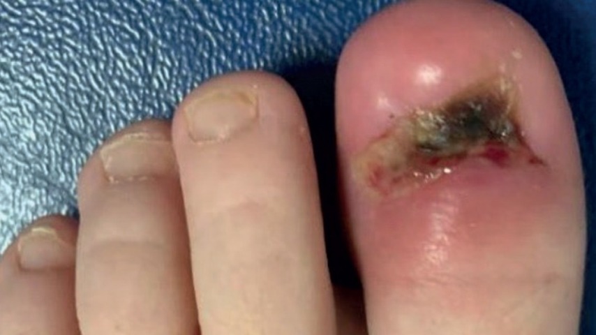 Ostéomyélite de l'orteil à Mycoplasma hominis: petite cause, grand effet !