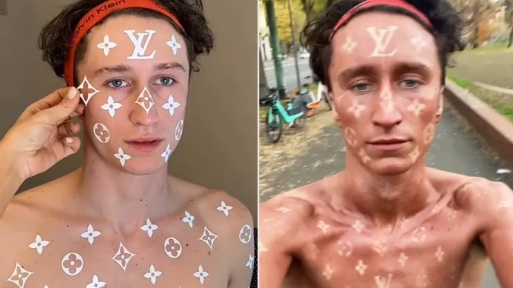 Cancer de la peau: Euromelanoma veut combattre le 'bullsh*t' en ligne