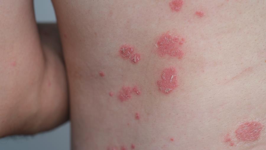Psoriasis : peut-on espacer les biothérapies ciblant l’IL-17 et l’IL-23 ?
